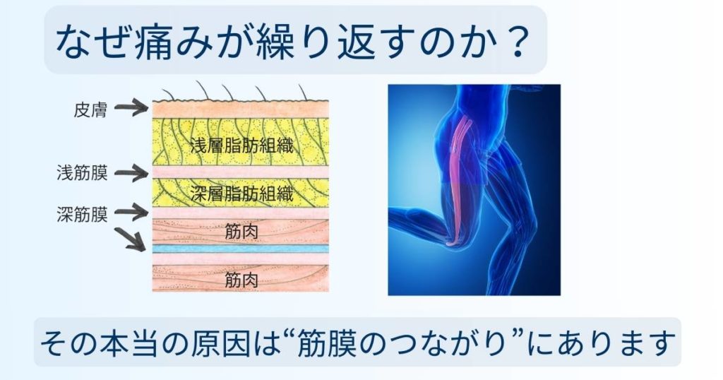 皮膚・浅筋膜・深筋膜の構造解説図と、太ももの筋膜のつながりのイメージ画像
