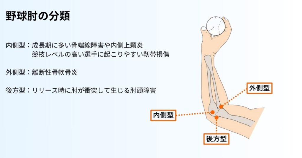 野球肘の原因となる投球時の外反ストレスと肘の内側・外側にかかる負担のメカニズムを図解